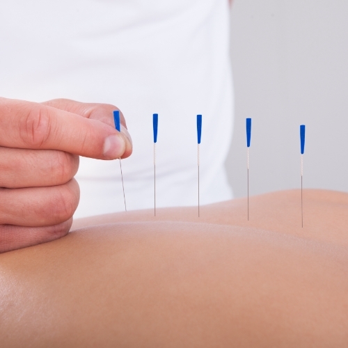 Dry-needling-Orthopedic-&-Balance-Therapy-Specialists-highland-crown-point-hobart-valparaiso-laporte-IN